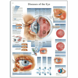 👁️🔬 3B Scientific VR1231UU Menschliche Anatomie, Krankheiten des Auges, Papierversion, unlaminiert - Angebot!