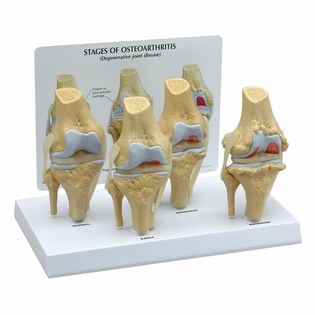 GPI Anatomicals 1100 Osteo-Kniemodellset 4 verschiedener Stadien
