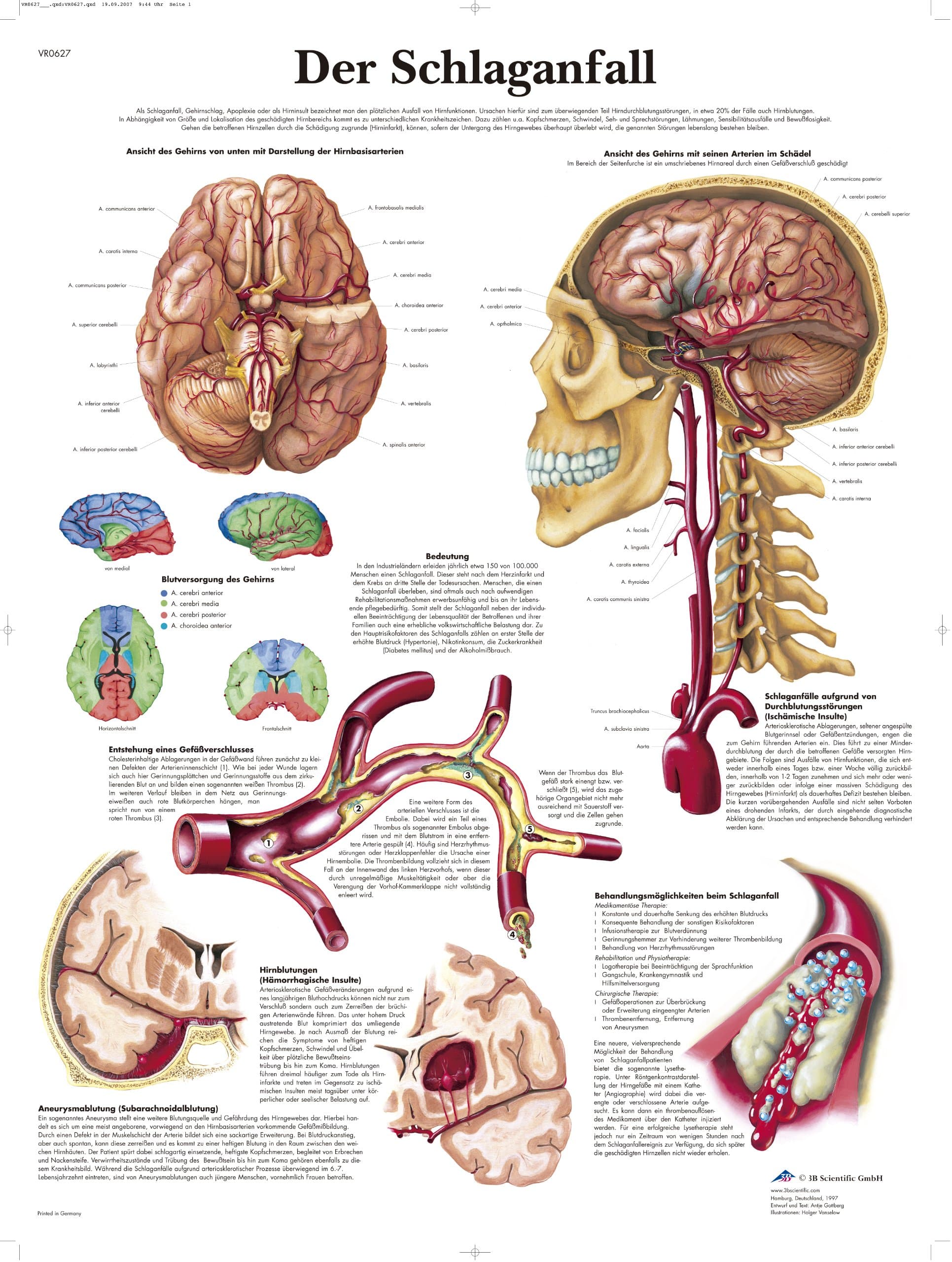 3B Scientific Lehrtafel - Der Schlaganfall, VR0627UU Papier