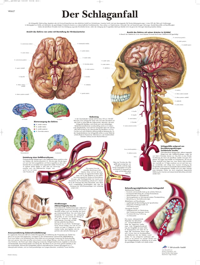 3B Scientific Lehrtafel - Der Schlaganfall, VR0627UU Papier